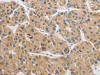 The image on the left is immunohistochemistry of paraffin-embedded Human liver cancer tissue using CSB-PA990163 (ARHGAP15 Antibody) at dilution 1/50, on the right is treated with fusion protein. (Original magnification: ×200)