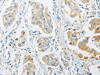 The image on the left is immunohistochemistry of paraffin-embedded Human breast cancer tissue using CSB-PA176345 (ARHGEF10 Antibody) at dilution 1/45, on the right is treated with fusion protein. (Original magnification: ×200)