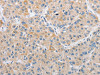 The image on the left is immunohistochemistry of paraffin-embedded Human liver cancer tissue using CSB-PA183796 (ARHGEF9 Antibody) at dilution 1/50, on the right is treated with fusion protein. (Original magnification: ×200)