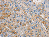 The image on the left is immunohistochemistry of paraffin-embedded Human liver cancer tissue using CSB-PA112219 (DIRAS3 Antibody) at dilution 1/25, on the right is treated with fusion protein. (Original magnification: ×200)