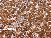 The image on the left is immunohistochemistry of paraffin-embedded Human thyroid cancer tissue using CSB-PA131138 (ARL4A Antibody) at dilution 1/50, on the right is treated with fusion protein. (Original magnification: ×200)