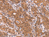 The image on the left is immunohistochemistry of paraffin-embedded Human gastric cancer tissue using CSB-PA068193 (ARL4A Antibody) at dilution 1/60, on the right is treated with fusion protein. (Original magnification: ×200)