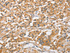 The image on the left is immunohistochemistry of paraffin-embedded Human thyroid cancer tissue using CSB-PA994626 (ARL8A Antibody) at dilution 1/20, on the right is treated with fusion protein. (Original magnification: ×200)