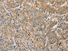 The image on the left is immunohistochemistry of paraffin-embedded Human gastric cancer tissue using CSB-PA994626 (ARL8A Antibody) at dilution 1/20, on the right is treated with fusion protein. (Original magnification: ×200)