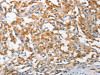 The image on the left is immunohistochemistry of paraffin-embedded Human thyroid cancer tissue using CSB-PA919511 (ARL8A Antibody) at dilution 1/25, on the right is treated with fusion protein. (Original magnification: ×200)
