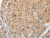 The image on the left is immunohistochemistry of paraffin-embedded Human liver cancer tissue using CSB-PA919511 (ARL8A Antibody) at dilution 1/25, on the right is treated with fusion protein. (Original magnification: ×200)