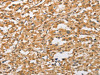 The image on the left is immunohistochemistry of paraffin-embedded Human thyroid cancer tissue using CSB-PA098497 (ARMCX1 Antibody) at dilution 1/40, on the right is treated with fusion protein. (Original magnification: ×200)