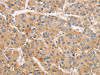 The image on the left is immunohistochemistry of paraffin-embedded Human liver cancer tissue using CSB-PA098497 (ARMCX1 Antibody) at dilution 1/40, on the right is treated with fusion protein. (Original magnification: ×200)