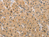 The image on the left is immunohistochemistry of paraffin-embedded Human liver cancer tissue using CSB-PA257054 (ARMCX1 Antibody) at dilution 1/40, on the right is treated with fusion protein. (Original magnification: ×200)