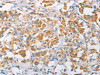 The image on the left is immunohistochemistry of paraffin-embedded Human thyroid cancer tissue using CSB-PA257054 (ARMCX1 Antibody) at dilution 1/40, on the right is treated with fusion protein. (Original magnification: ×200)