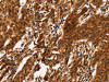 The image on the left is immunohistochemistry of paraffin-embedded Human gastric cancer tissue using CSB-PA157358 (ARL6IP1 Antibody) at dilution 1/20, on the right is treated with fusion protein. (Original magnification: ×200)
