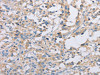 The image on the left is immunohistochemistry of paraffin-embedded Human thyroid cancer tissue using CSB-PA102745 (ACTR2 Antibody) at dilution 1/30, on the right is treated with fusion protein. (Original magnification: ×200)