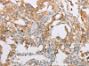 The image on the left is immunohistochemistry of paraffin-embedded Human thyroid cancer tissue using CSB-PA786075 (ACTR2 Antibody) at dilution 1/40, on the right is treated with fusion protein. (Original magnification: ×200)