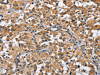 The image on the left is immunohistochemistry of paraffin-embedded Human thyroid cancer tissue using CSB-PA930678 (FLT3 Antibody) at dilution 1/50, on the right is treated with fusion protein. (Original magnification: ×200)