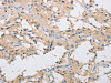 The image on the left is immunohistochemistry of paraffin-embedded Human thyroid cancer tissue using CSB-PA795347 (IKBKG Antibody) at dilution 1/40, on the right is treated with fusion protein. (Original magnification: ×200)