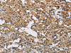The image on the left is immunohistochemistry of paraffin-embedded Human thyroid cancer tissue using CSB-PA522891 (DNMT3A Antibody) at dilution 1/50, on the right is treated with fusion protein. (Original magnification: ×200)