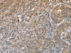 The image on the left is immunohistochemistry of paraffin-embedded Human gastric cancer tissue using CSB-PA522891 (DNMT3A Antibody) at dilution 1/50, on the right is treated with fusion protein. (Original magnification: ×200)