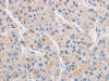 The image on the left is immunohistochemistry of paraffin-embedded Human liver cancer tissue using CSB-PA558670 (KAT5 Antibody) at dilution 1/20, on the right is treated with fusion protein. (Original magnification: ×200)