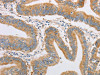 The image on the left is immunohistochemistry of paraffin-embedded Human colon cancer tissue using CSB-PA143333 (FARSB Antibody) at dilution 1/20, on the right is treated with fusion protein. (Original magnification: ×200)