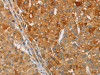 The image on the left is immunohistochemistry of paraffin-embedded Human liver cancer tissue using CSB-PA909692 (ARSG Antibody) at dilution 1/30, on the right is treated with fusion protein. (Original magnification: ×200)