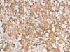 The image on the left is immunohistochemistry of paraffin-embedded Human thyroid cancer tissue using CSB-PA945784 (ART3 Antibody) at dilution 1/40, on the right is treated with fusion protein. (Original magnification: ×200)