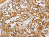 The image on the left is immunohistochemistry of paraffin-embedded Human thyroid cancer tissue using CSB-PA278026 (ART3 Antibody) at dilution 1/40, on the right is treated with fusion protein. (Original magnification: ×200) The image on the left is immunohistochemistry of paraffin-embedded Human thyroid cancer tissue using CSB-PA278026 (ART3 Antibody) at dilution 1/40, on the right is treated with fusion protein. (Original magnification: ×200)