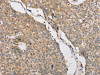 The image on the left is immunohistochemistry of paraffin-embedded Human lung cancer tissue using CSB-PA278026 (ART3 Antibody) at dilution 1/40, on the right is treated with fusion protein. (Original magnification: ×200) The image on the left is immunohistochemistry of paraffin-embedded Human lung cancer tissue using CSB-PA278026 (ART3 Antibody) at dilution 1/40, on the right is treated with fusion protein. (Original magnification: ×200)