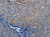 The image on the left is immunohistochemistry of paraffin-embedded Human cervical cancer tissue using CSB-PA258120 (INTS10 Antibody) at dilution 1/50, on the right is treated with fusion protein. (Original magnification: ×200)