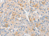 The image on the left is immunohistochemistry of paraffin-embedded Human liver cancer tissue using CSB-PA585936 (TLR4 Antibody) at dilution 1/50, on the right is treated with fusion protein. (Original magnification: ×200)