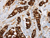 The image on the left is immunohistochemistry of paraffin-embedded Human breast cancer tissue using CSB-PA086865 (TLR6 Antibody) at dilution 1/25, on the right is treated with fusion protein. (Original magnification: ×200)