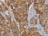 The image on the left is immunohistochemistry of paraffin-embedded Human breast cancer tissue using CSB-PA226880 (TLR6 Antibody) at dilution 1/25, on the right is treated with fusion protein. (Original magnification: ×200)