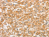 The image on the left is immunohistochemistry of paraffin-embedded Human thyroid cancer tissue using CSB-PA697913 (TLR3 Antibody) at dilution 1/50, on the right is treated with fusion protein. (Original magnification: ×200)