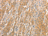 The image on the left is immunohistochemistry of paraffin-embedded Human gastric cancer tissue using CSB-PA697913 (TLR3 Antibody) at dilution 1/50, on the right is treated with fusion protein. (Original magnification: ×200)