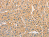 The image on the left is immunohistochemistry of paraffin-embedded Human liver cancer tissue using CSB-PA157170 (TLR3 Antibody) at dilution 1/40, on the right is treated with fusion protein. (Original magnification: ×200)