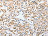 The image on the left is immunohistochemistry of paraffin-embedded Human thyroid cancer tissue using CSB-PA561195 (UCHL5 Antibody) at dilution 1/25, on the right is treated with fusion protein. (Original magnification: ×200)