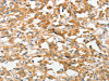 The image on the left is immunohistochemistry of paraffin-embedded Human thyroid cancer tissue using CSB-PA195221 (UCHL5 Antibody) at dilution 1/20, on the right is treated with fusion protein. (Original magnification: ×200)