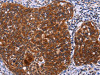 The image on the left is immunohistochemistry of paraffin-embedded Human cervical cancer tissue using CSB-PA155084 (USP2 Antibody) at dilution 1/40, on the right is treated with fusion protein. (Original magnification: ×200)