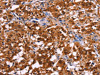 The image on the left is immunohistochemistry of paraffin-embedded Human thyroid cancer tissue using CSB-PA155084 (USP2 Antibody) at dilution 1/40, on the right is treated with fusion protein. (Original magnification: ×200)