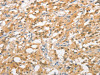 The image on the left is immunohistochemistry of paraffin-embedded Human thyroid cancer tissue using CSB-PA945911 (UBQLN1 Antibody) at dilution 1/20, on the right is treated with fusion protein. (Original magnification: ×200)