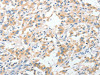 The image on the left is immunohistochemistry of paraffin-embedded Human thyroid cancer tissue using CSB-PA233350 (RPN1 Antibody) at dilution 1/30, on the right is treated with fusion protein. (Original magnification: ×200)