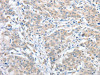 The image on the left is immunohistochemistry of paraffin-embedded Human gastric cancer tissue using CSB-PA579544 (RPN1 Antibody) at dilution 1/25, on the right is treated with fusion protein. (Original magnification: ×200)