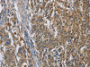 The image is immunohistochemistry of paraffin-embedded Human gastic cancer tissue using CSB-PA209031 (SIGMAR1 Antibody) at dilution 1/50. (Original magnification: ×200)