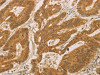 The image on the left is immunohistochemistry of paraffin-embedded Human colon cancer tissue using CSB-PA558008 (PSMB7 Antibody) at dilution 1/25, on the right is treated with fusion protein. (Original magnification: ×200)