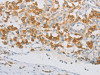 The image on the left is immunohistochemistry of paraffin-embedded Human thyroid cancer tissue using CSB-PA284388 (REN Antibody) at dilution 1/40, on the right is treated with fusion protein. (Original magnification: ×200)