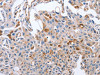 The image on the left is immunohistochemistry of paraffin-embedded Human lung cancer tissue using CSB-PA278214 (NRG4 Antibody) at dilution 1/60, on the right is treated with fusion protein. (Original magnification: ×200)