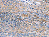 The image on the left is immunohistochemistry of paraffin-embedded Human cervical cancer tissue using CSB-PA278214 (NRG4 Antibody) at dilution 1/60, on the right is treated with fusion protein. (Original magnification: ×200)