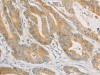 The image on the left is immunohistochemistry of paraffin-embedded Human colon cancer tissue using CSB-PA030465 (ZWINT Antibody) at dilution 1/50, on the right is treated with fusion protein. (Original magnification: ×200)