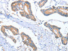 The image on the left is immunohistochemistry of paraffin-embedded Human colon cancer tissue using CSB-PA598045 (MTMR7 Antibody) at dilution 1/40, on the right is treated with fusion protein. (Original magnification: ×200)