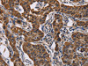 The image on the left is immunohistochemistry of paraffin-embedded Human lung cancer tissue using CSB-PA913546 (ADRBK2 Antibody) at dilution 1/50, on the right is treated with fusion protein. (Original magnification: ×200)