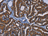 The image on the left is immunohistochemistry of paraffin-embedded Human thyroid cancer tissue using CSB-PA648744 (ADRBK2 Antibody) at dilution 1/40, on the right is treated with fusion protein. (Original magnification: ×200)